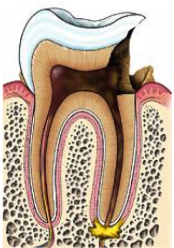 caries dentaires 4